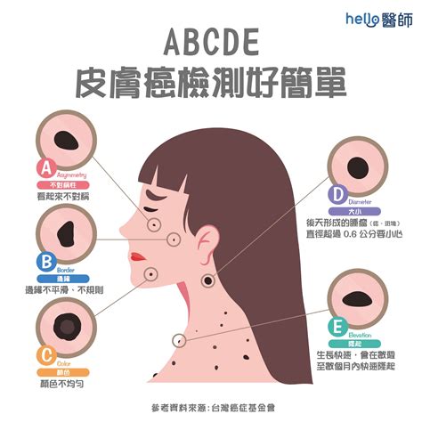 痣 生成原因|痣變大、痣多或長毛會變皮膚癌？認識痣的形成與原因